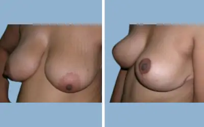 Before and After